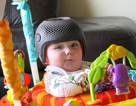 Helmet Therapy for Babies