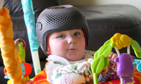 Helmet Therapy for Babies