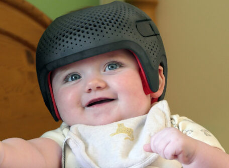 Helmet therapy