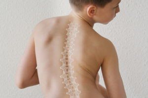 Scoliosis