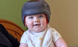 Plagiocephaly Helmet