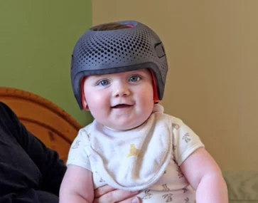Plagiocephaly Helmet