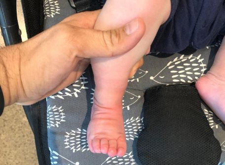 bone tumor in leg dubai