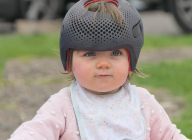 plagiocephaly helmet