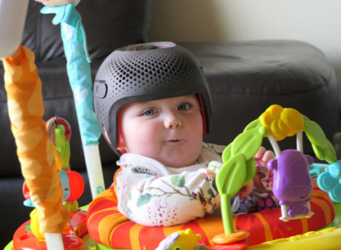 helmet therapy